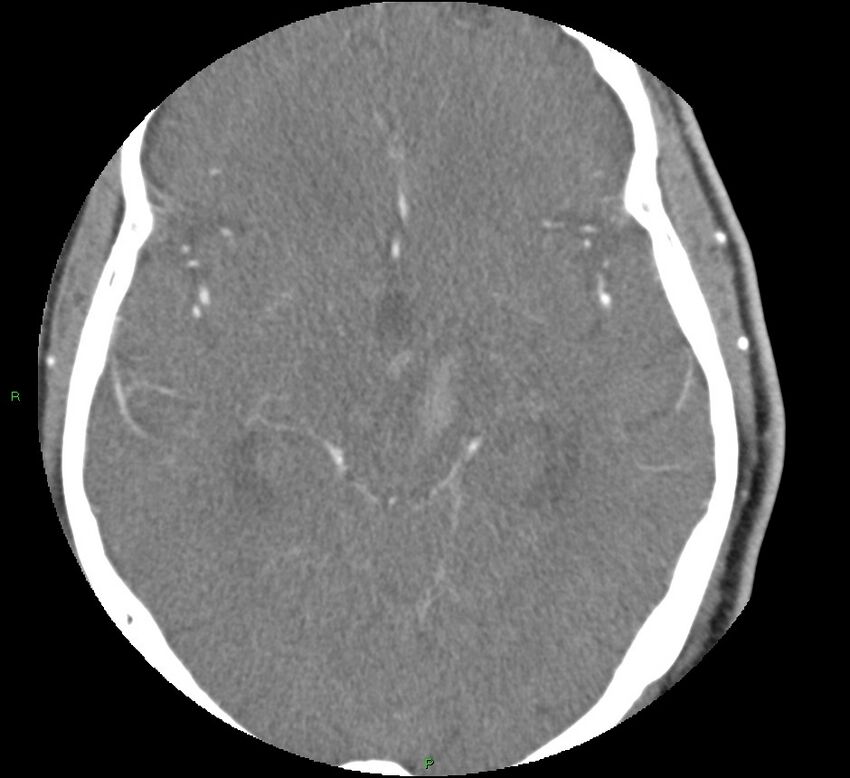 Brainstem hemorrhage (Radiopaedia 58794-66028 D 87).jpg