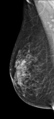 Breast hamartoma (Radiopaedia 85726-101518 Right MLO 1).PNG