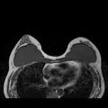 Breast implants - MRI (Radiopaedia 26864-27035 Axial T1 24).jpg