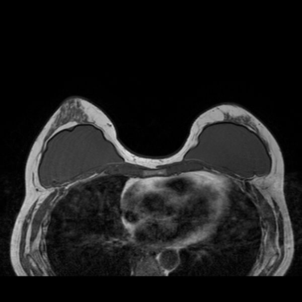 File:Breast implants - MRI (Radiopaedia 26864-27035 Axial T1 24).jpg