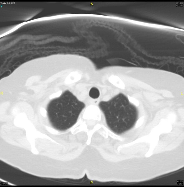 File:Breast primary with lung and bone metastases (Radiopaedia 40620-43228 Axial lung window 7).jpg