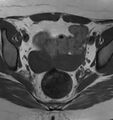 Broad ligament leiomyoma (Radiopaedia 81634-95516 Axial T1 13).jpg
