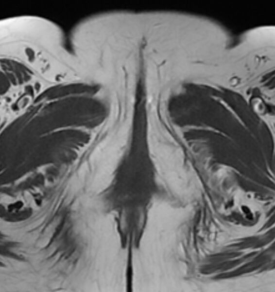 File:Broad ligament leiomyoma (Radiopaedia 81634-95516 Axial T1 30).jpg