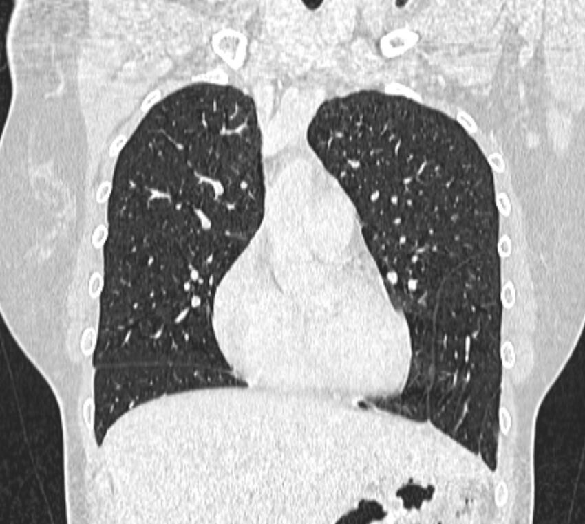 Bronchial atresia (Radiopaedia 50007-55297 Coronal lung window 31).jpg