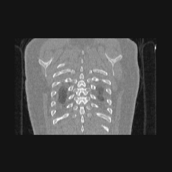 File:Bronchial atresia (Radiopaedia 60685-68439 Coronal lung window 6).jpg