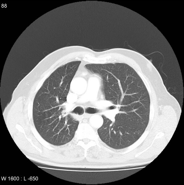 File:Bronchial carcinoid tumor with right lower lobe collapse (Radiopaedia 29060-29422 B 26).jpg