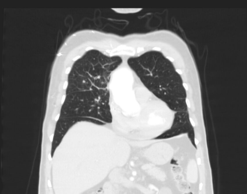 Bronchogenic carcinoma with lymphangitic spread (Radiopaedia 29002-29357 Coronal lung window 20).jpg