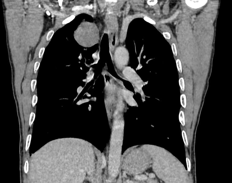 File:Bronchogenic carcinoma with superior vena cava syndrome (Radiopaedia 36497-38054 Coronal C+ delayed 61).jpg