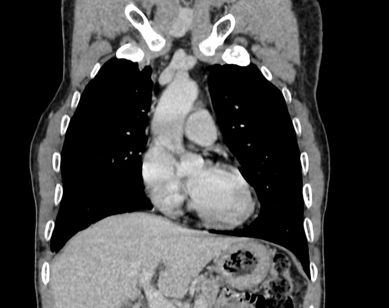 File:Bronchogenic carcinoma with superior vena cava syndrome (Radiopaedia 36497-38054 Coronal C+ delayed 9).jpg