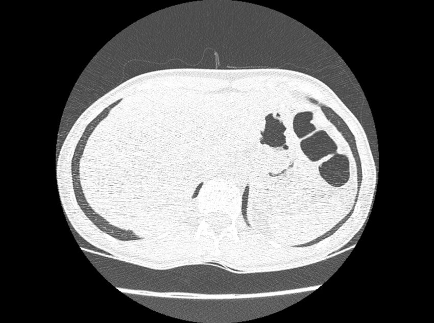 Bronchogenic cyst (Radiopaedia 80273-93615 Axial lung window 44).jpg