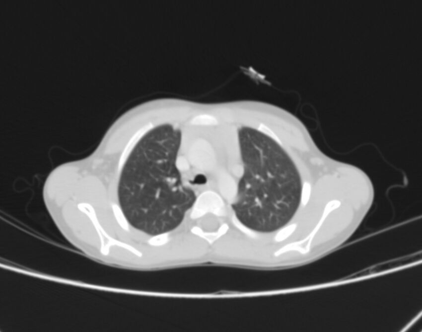 Bronchus suis (Radiopaedia 68131-77620 Axial lung window 13).jpg