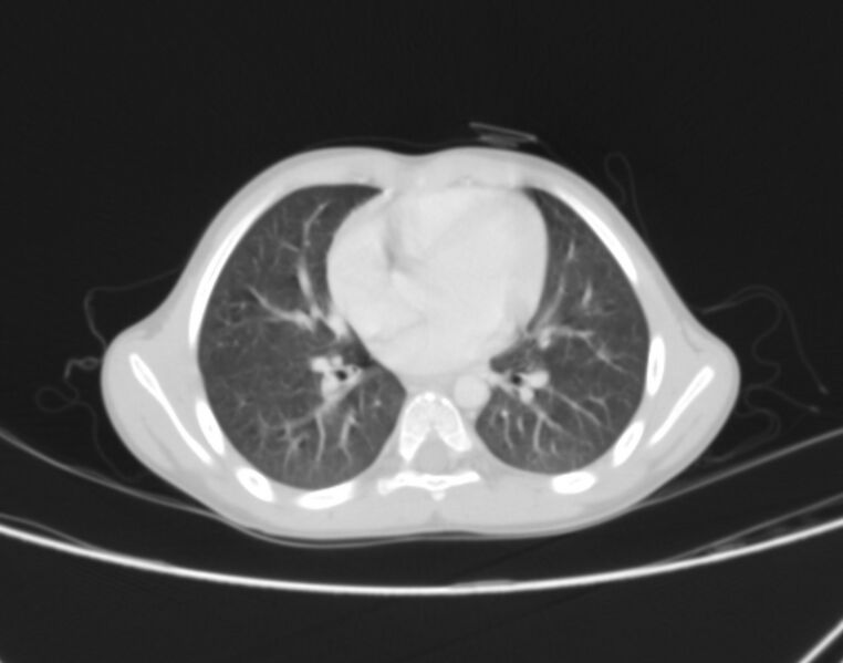 File:Bronchus suis (Radiopaedia 68131-77620 Axial lung window 52).jpg