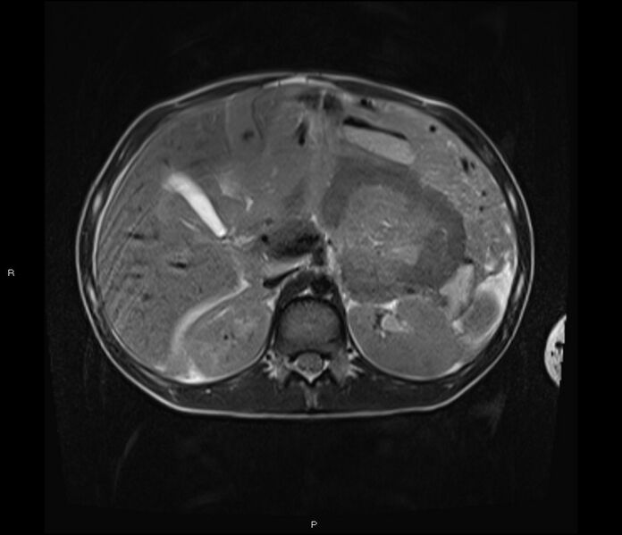 File:Burkitt lymphoma (bowel) (Radiopaedia 68839-78557 Axial T2 20).jpg