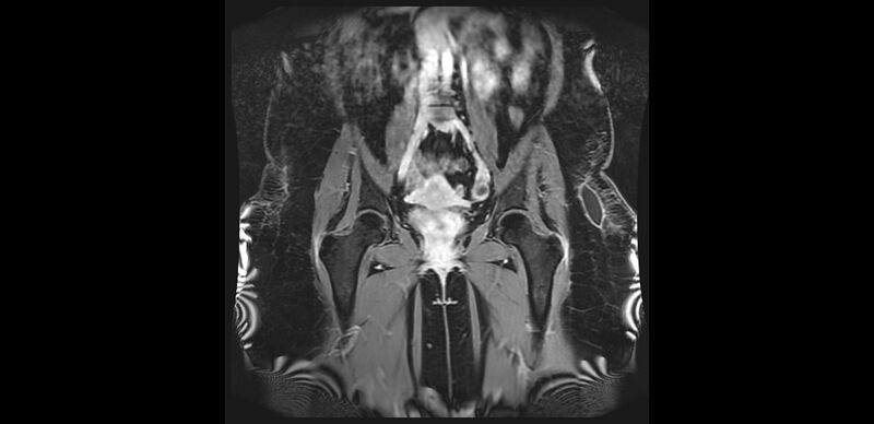 File:Buttock filler complications (Radiopaedia 63497-72115 Coronal T1 C+ 16).jpg