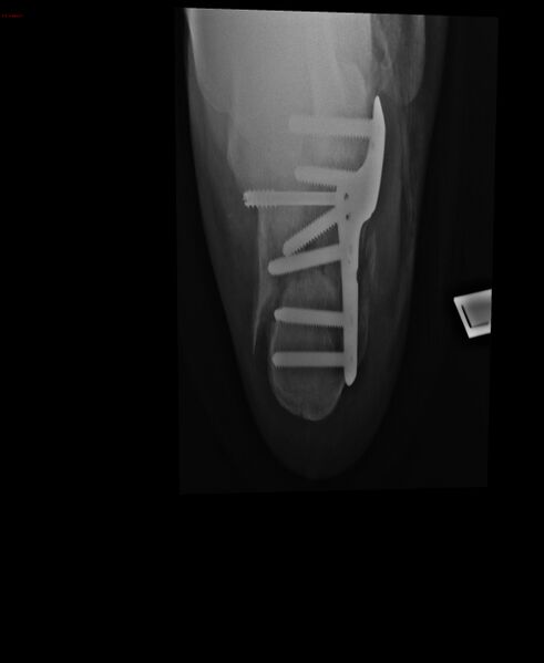File:Calcaneal fracture and associated spinal injury (Radiopaedia 17896-17660 A 1).jpg
