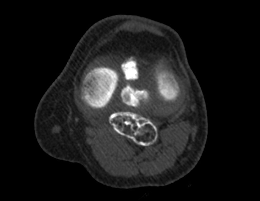 Calcified hematoma - popliteal fossa (Radiopaedia 63938-72763 Axial bone window 22).jpg