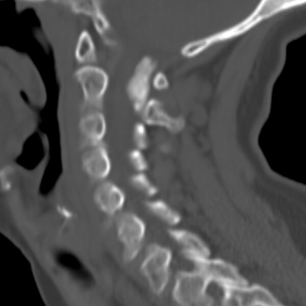 File:Calcified meningioma - cervical canal (Radiopaedia 70136-80171 Sagittal bone window 23).jpg