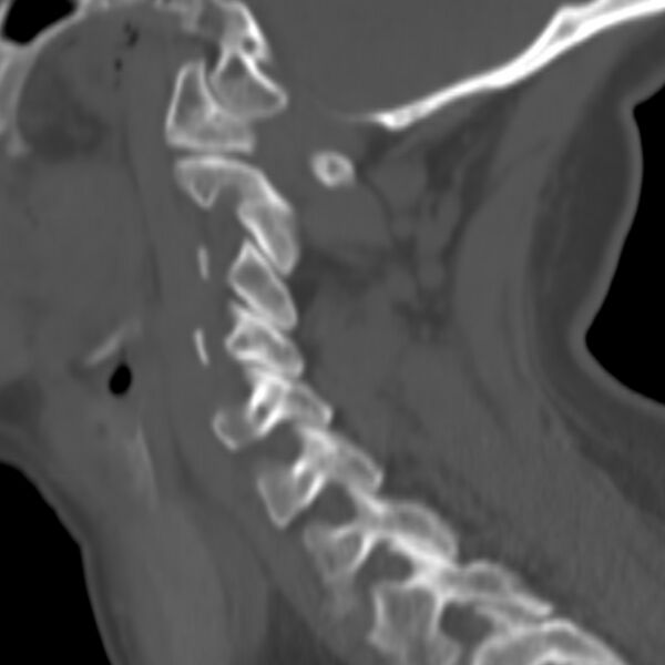 File:Calcified meningioma - cervical canal (Radiopaedia 70136-80171 Sagittal bone window 5).jpg