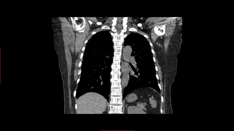 File:Calcified spleen (Radiopaedia 60952-68768 Coronal non-contrast 4).jpg