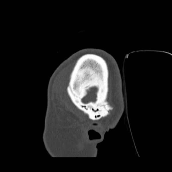 File:Calvarial osteoma (Radiopaedia 36520-38079 Sagittal bone window 9).jpg