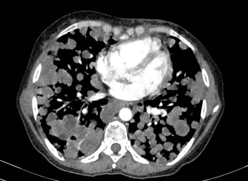 File:Cannonball metastases from breast cancer (Radiopaedia 91024-108569 A 77).jpg