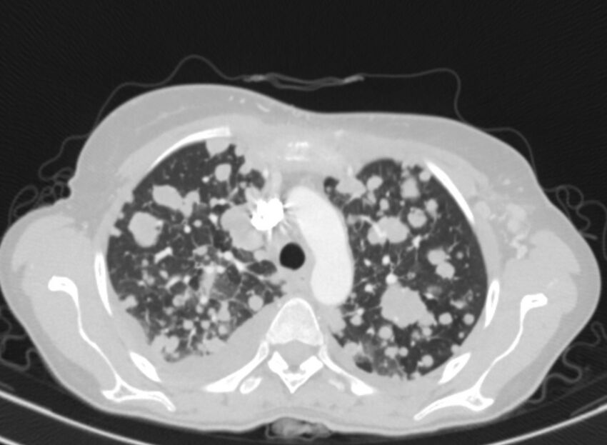 Cannonball metastases from breast cancer (Radiopaedia 91024-108569 Axial lung window 24).jpg