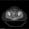 Carcinoma cervix- brachytherapy applicator (Radiopaedia 33135-34173 Axial non-contrast 26).jpg