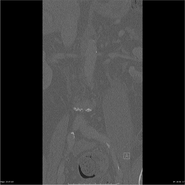 File:Cardiac trauma (Radiopaedia 32874-33858 Coronal bone window 25).jpg