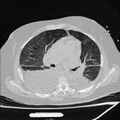 Cardiogenic pulmonary edema (Radiopaedia 29213-29609 Axial lung window 42).jpg