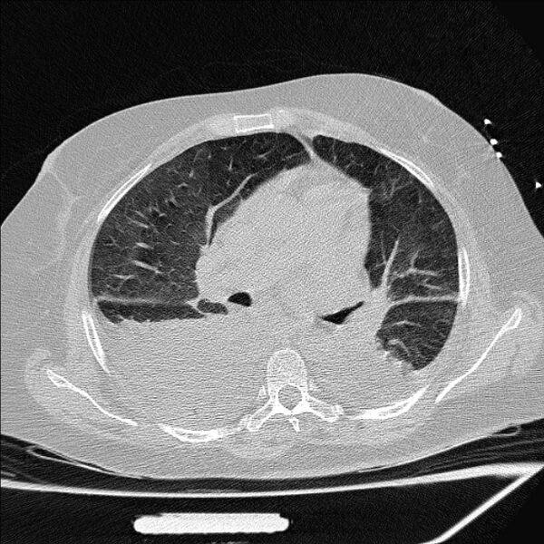 File:Cardiogenic pulmonary edema (Radiopaedia 29213-29609 Axial lung window 42).jpg