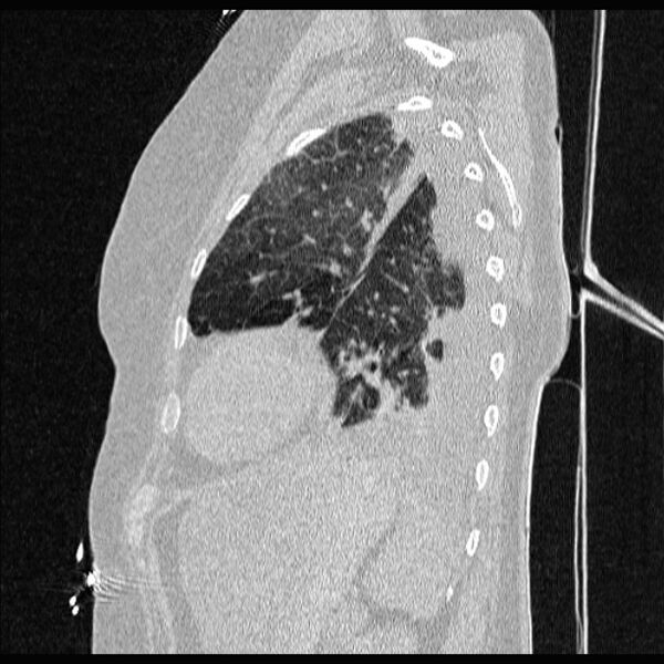 File:Cardiogenic pulmonary edema (Radiopaedia 29213-29609 Sagittal lung window 75).jpg