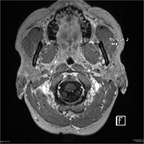 File:Cavernous malformation (cavernous angioma or cavernoma) (Radiopaedia 36675-38237 Axial T1 C+ 1).jpg