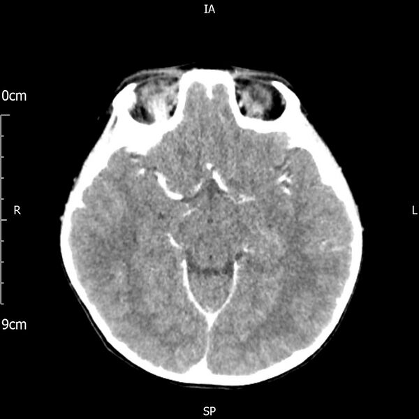 File:Cavernous sinus thrombosis (Radiopaedia 79414-92510 Axial Brain 93).jpg