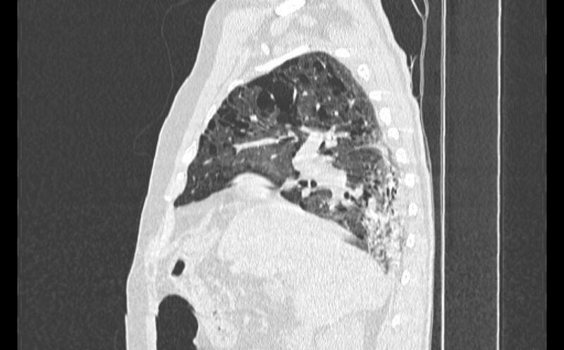 File:Cavitating bronchogenic carcinoma (Radiopaedia 44489-48162 Sagittal lung window 16).jpg