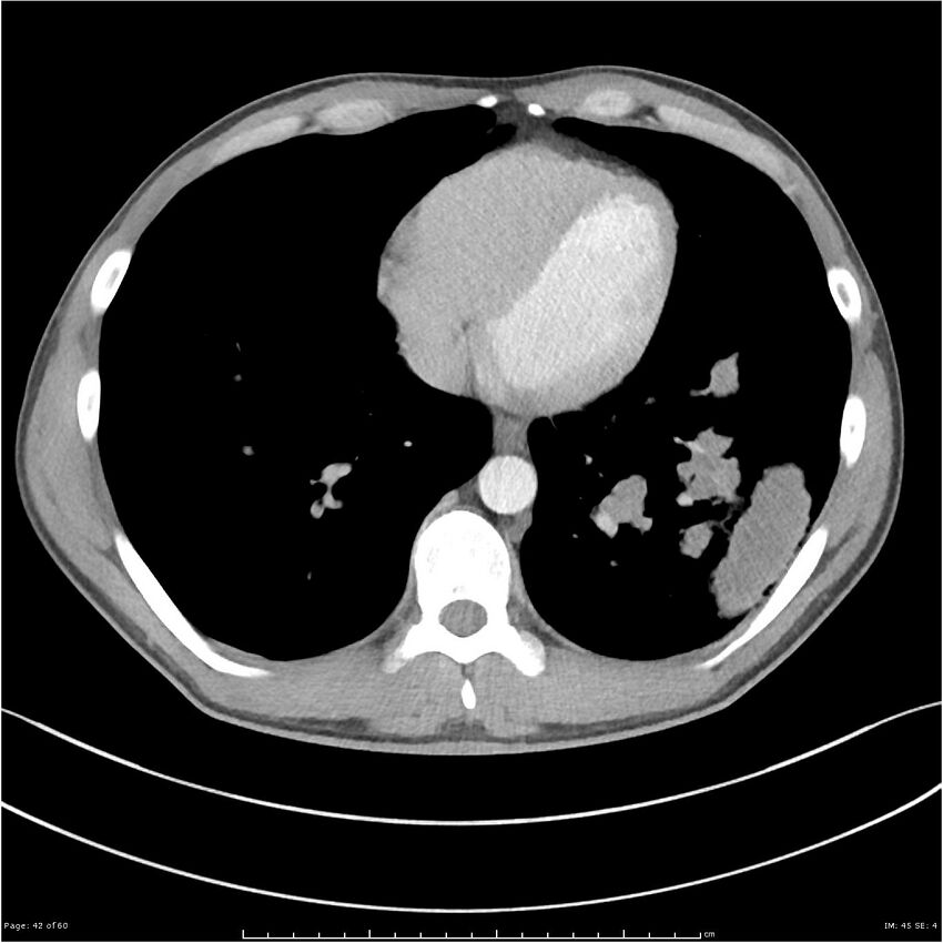 Cavitating lung cancer (Radiopaedia 25796-25945 C+ arterial phase 42).jpg