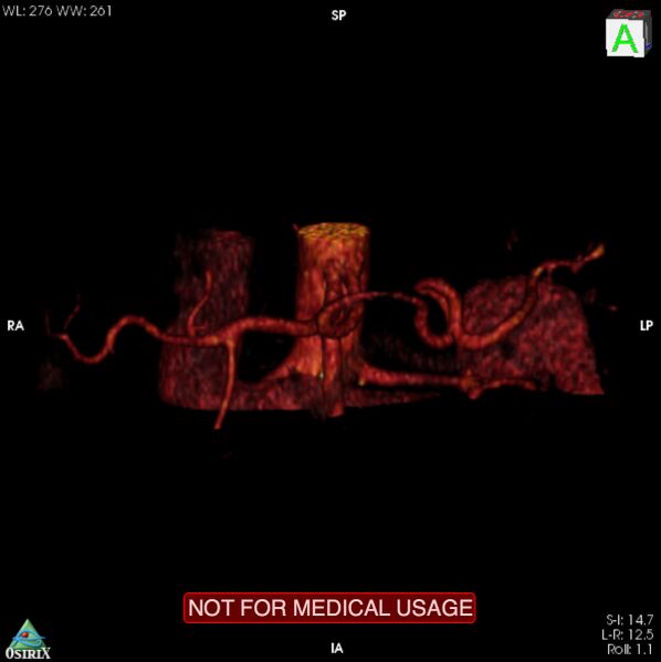 File:Celiac trunk variant anatomy - gastrohepatic trunk and splenic artery (Radiopaedia 38815-40995 B 11).jpg