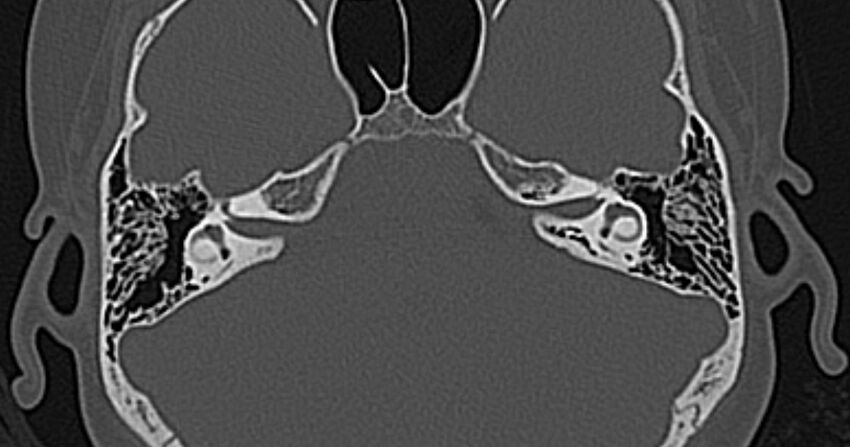 Cerebellopontine angle lipoma (Radiopaedia 57303-64242 Axial bone window 34).jpg