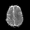 Cerebral abscess post cardiac surgery (Radiopaedia 27244-27420 Axial ADC 18).jpg