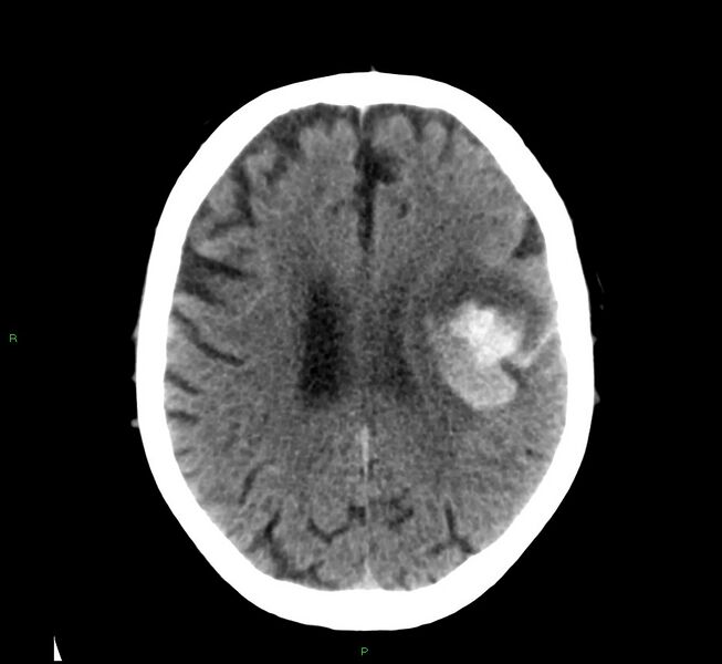File:Cerebral amyloid angiopathy-associated lobar intracerebral hemorrhage (Radiopaedia 58376-65511 Axial non-contrast 22).jpg