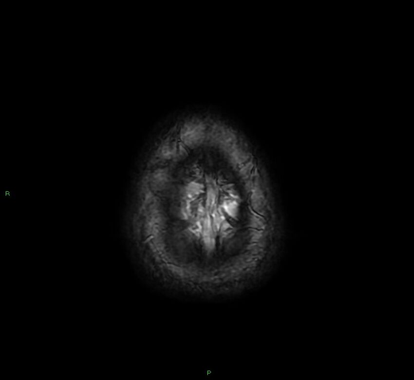 Cerebral amyloid angiopathy-associated lobar intracerebral hemorrhage (Radiopaedia 58378-65517 Axial SWI 72).jpg