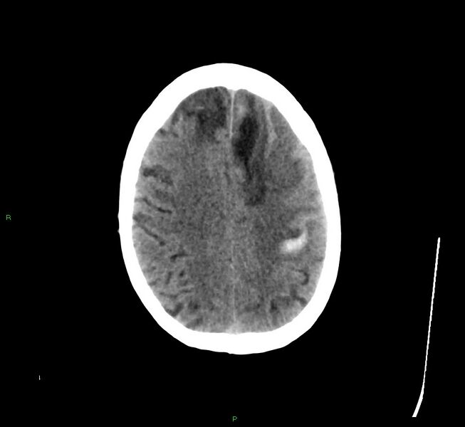 File:Cerebral amyloid angiopathy-associated lobar intracerebral hemorrhage (Radiopaedia 58529-65681 Axial non-contrast 15).jpg