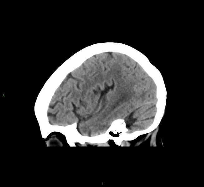 File:Cerebral amyloid angiopathy-associated lobar intracerebral hemorrhage (Radiopaedia 58563-65727 C 40).jpg