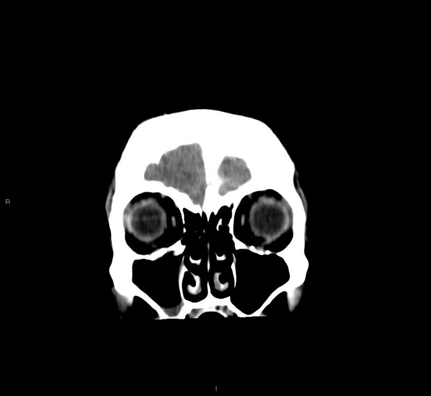 Cerebral amyloid angiopathy-associated lobar intracerebral hemorrhage (Radiopaedia 58756-65977 Coronal non-contrast 56).jpg