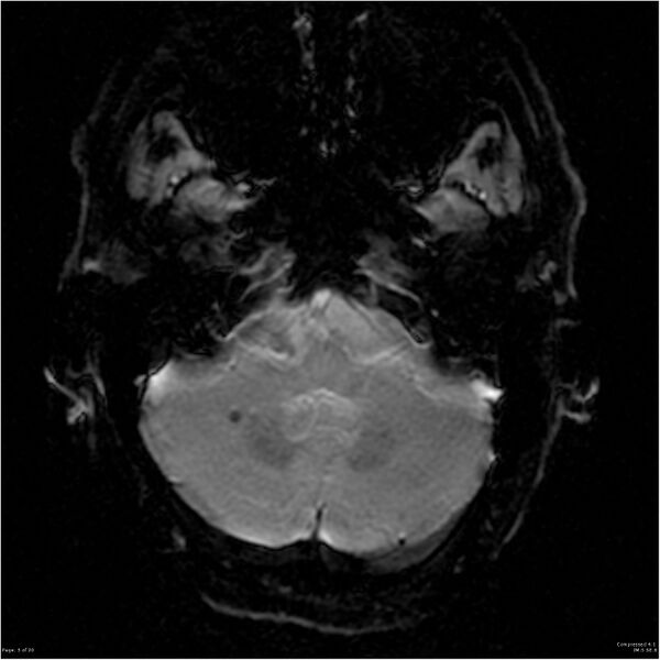 File:Cerebral amyloid angiopathy (Radiopaedia 15826).jpg
