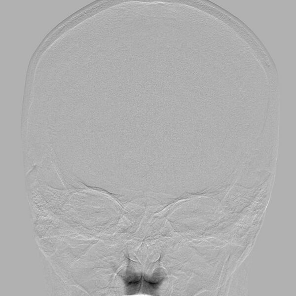 File:Cerebral aneurysm with rupture (Radiopaedia 29933-30458 LT CCA IC 2).jpg
