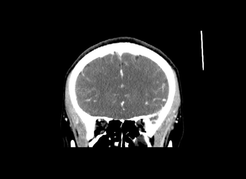 File:Cerebral edema (Radiopaedia 82519-96661 C 44).jpg