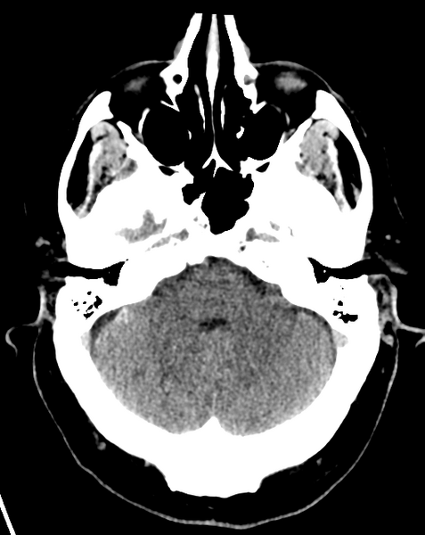 File:Cerebral embolic infarcts (embolic shower) (Radiopaedia 57395-64341 Axial non-contrast 8).png