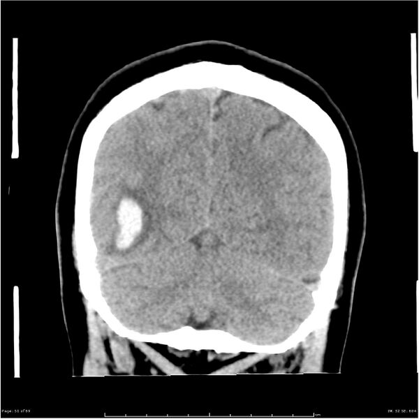File:Cerebral hemorrhage secondary to arteriovenous malformation (Radiopaedia 33497-34561 Coronal non-contrast 42).jpg