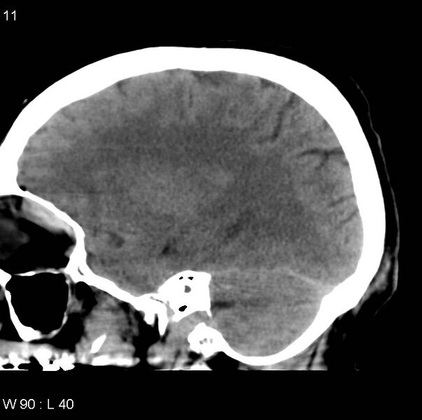 File:Cerebral hemorrhagic contusion with subdural and subarachnoid hemorrhage (Radiopaedia 10680-11146 C 4).jpg