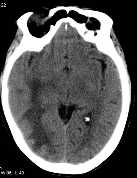 File:Cerebral metastasis - lung cancer (Radiopaedia 5315-7072 Axial non-contrast 1).jpg